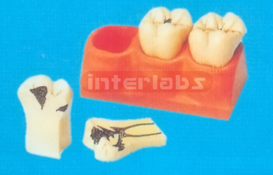 DENTAL CANIES DECOMPOSITION TOOTH MODEL